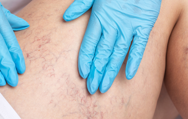 Telangiectasia