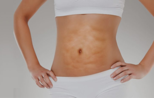 Fibrose ou queloide