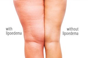 Lipedema não tratado