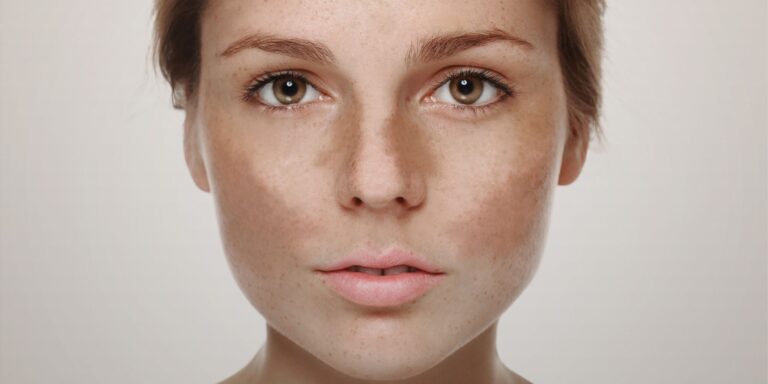 rosto feminino com melasma
