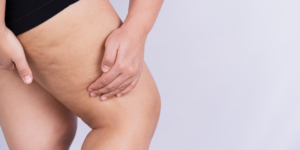 Psicologia e Lipedema: Impacto psicológico e questões emocionais