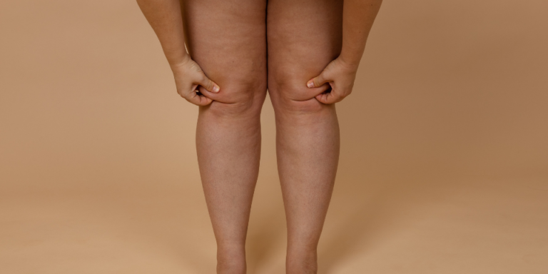 Causas do Lipedema, diagnóstico e tratamento