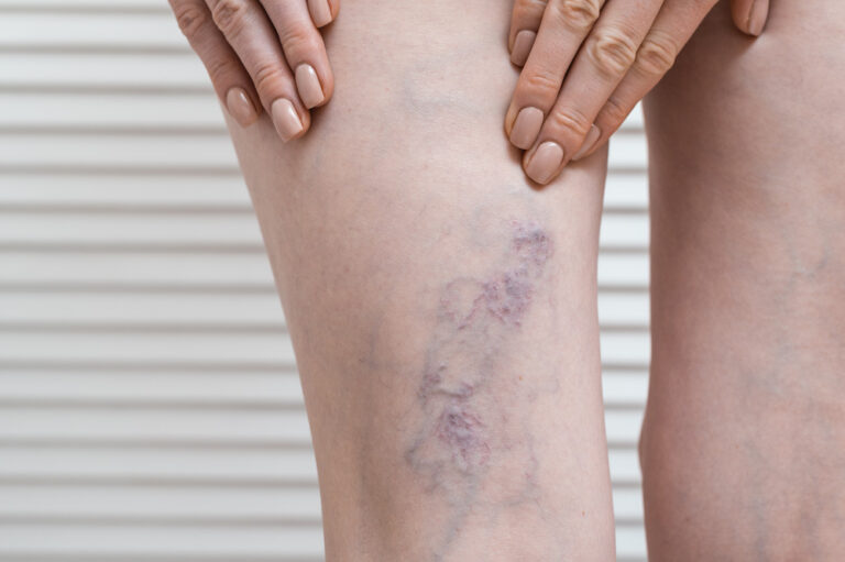 lipedema_varizes