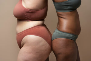 lipedema_tratamento